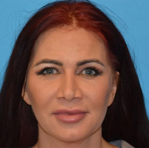 Beautify-Life Lift Real Patient Results by Dr. Scott Urban in Salt Lake City, Utah