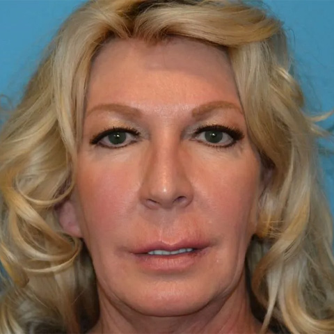 Beautify-Life Lift Real Patient Results by Dr. Scott Urban in Salt Lake City, Utah