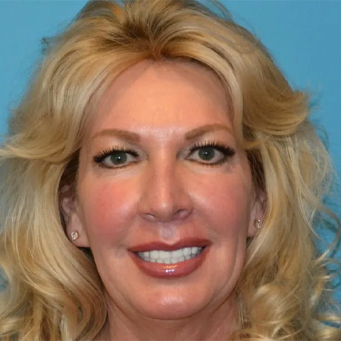 Beautify-Life Lift Real Patient Results by Dr. Scott Urban in Salt Lake City, Utah