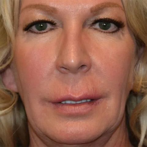 Beautify-Life Lift Real Patient Results by Dr. Scott Urban in Salt Lake City, Utah