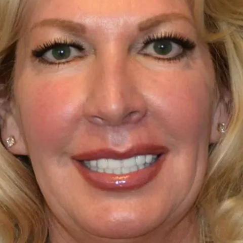 Beautify-Life Lift Real Patient Results by Dr. Scott Urban in Salt Lake City, Utah