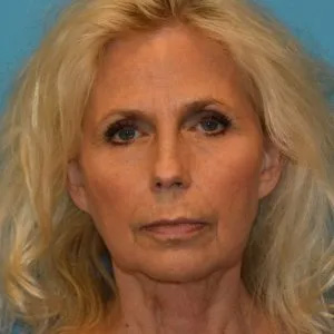 Beautify-Life Lift Real Patient Results by Dr. Scott Urban in Salt Lake City, Utah