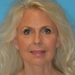 Beautify-Life Lift Real Patient Results by Dr. Scott Urban in Salt Lake City, Utah