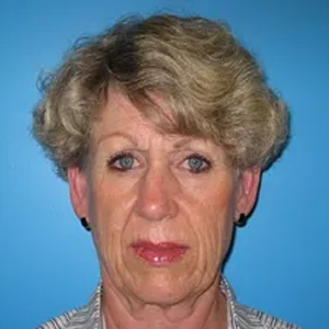 Beautify-Life Lift Real Patient Results by Dr. Scott Urban in Salt Lake City, Utah