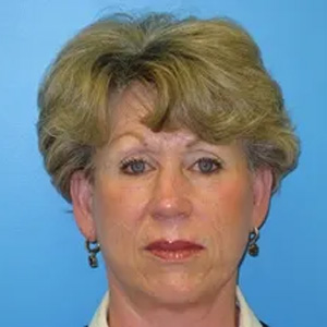 Beautify-Life Lift Real Patient Results by Dr. Scott Urban in Salt Lake City, Utah