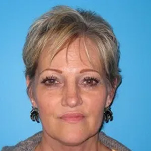 Beautify-Life Lift Real Patient Results by Dr. Scott Urban in Salt Lake City, Utah