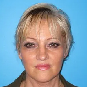 Beautify-Life Lift Real Patient Results by Dr. Scott Urban in Salt Lake City, Utah