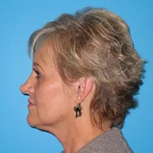 Beautify-Life Lift Real Patient Results by Dr. Scott Urban in Salt Lake City, Utah