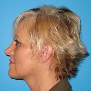 Beautify-Life Lift Real Patient Results by Dr. Scott Urban in Salt Lake City, Utah