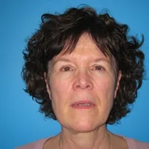 Beautify-Life Lift Real Patient Results by Dr. Scott Urban in Salt Lake City, Utah