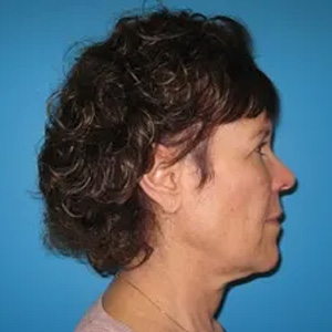 Beautify-Life Lift Real Patient Results by Dr. Scott Urban in Salt Lake City, Utah