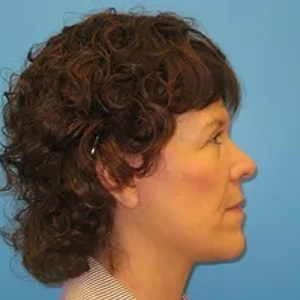 Beautify-Life Lift Real Patient Results by Dr. Scott Urban in Salt Lake City, Utah