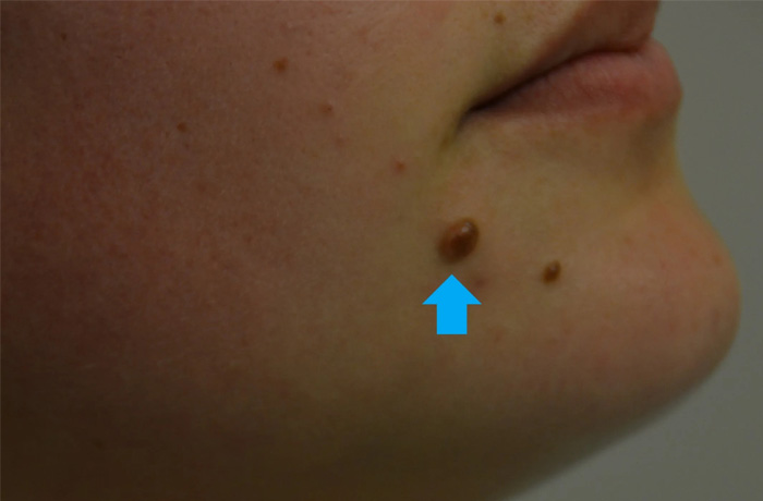 Mole Removal Real Patient Results by Dr. Scott Urban in Salt Lake City, Utah