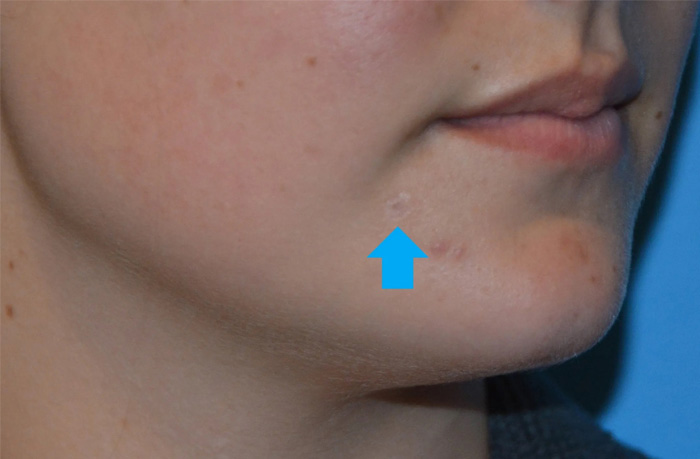Mole Removal Real Patient Results by Dr. Scott Urban in Salt Lake City, Utah
