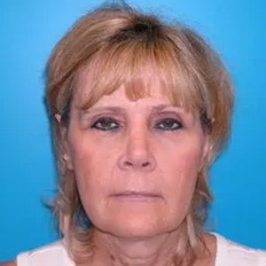 Beautify-Life Lift Real Patient Results by Dr. Scott Urban in Salt Lake City, Utah