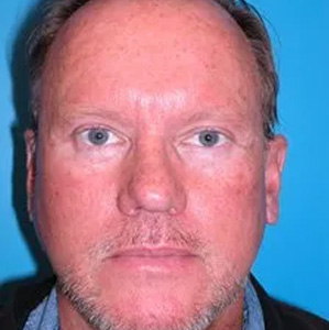 Beautify-Life Lift Real Patient Results by Dr. Scott Urban in Salt Lake City, Utah