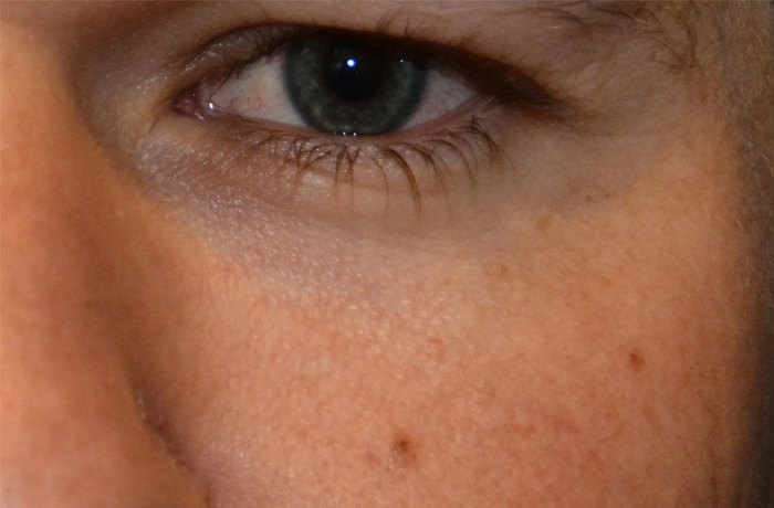 Mole Removal Real Patient Results by Dr. Scott Urban in Salt Lake City, Utah