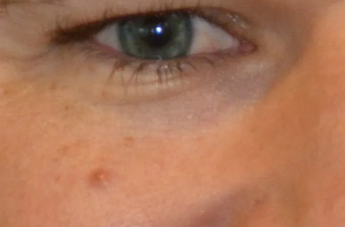 Mole Removal Real Patient Results by Dr. Scott Urban in Salt Lake City, Utah