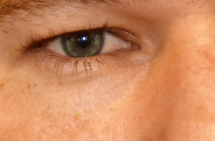 Mole Removal Real Patient Results by Dr. Scott Urban in Salt Lake City, Utah