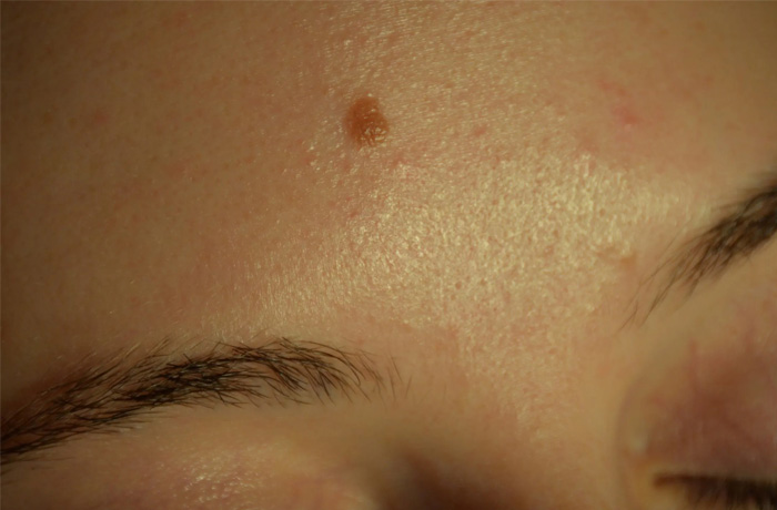 Mole Removal Real Patient Results by Dr. Scott Urban in Salt Lake City, Utah