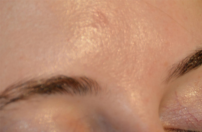 Mole Removal Real Patient Results by Dr. Scott Urban in Salt Lake City, Utah