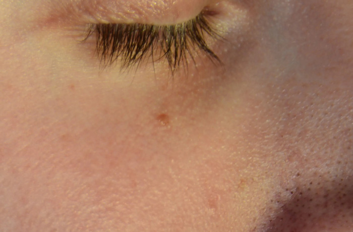 Mole Removal Real Patient Results by Dr. Scott Urban in Salt Lake City, Utah