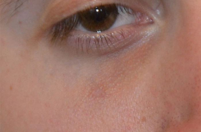 Mole Removal Real Patient Results by Dr. Scott Urban in Salt Lake City, Utah