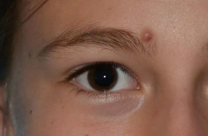 Mole Removal Real Patient Results by Dr. Scott Urban in Salt Lake City, Utah