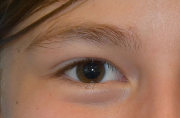 Mole Removal Real Patient Results by Dr. Scott Urban in Salt Lake City, Utah
