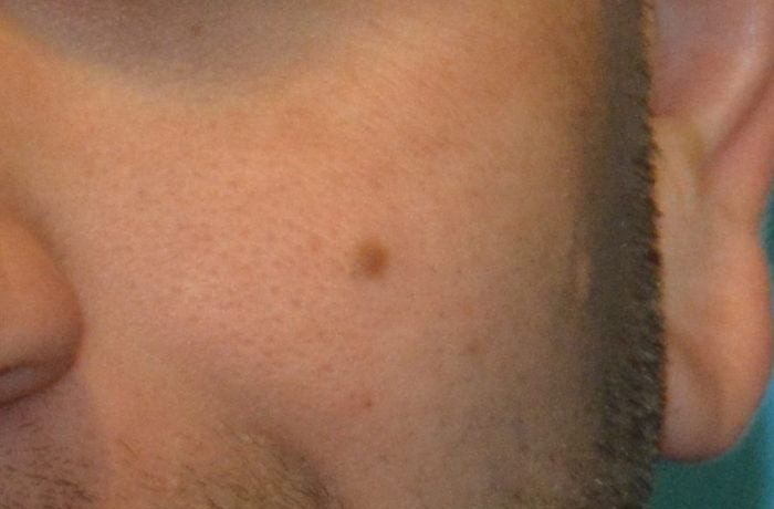 Mole Removal Real Patient Results by Dr. Scott Urban in Salt Lake City, Utah