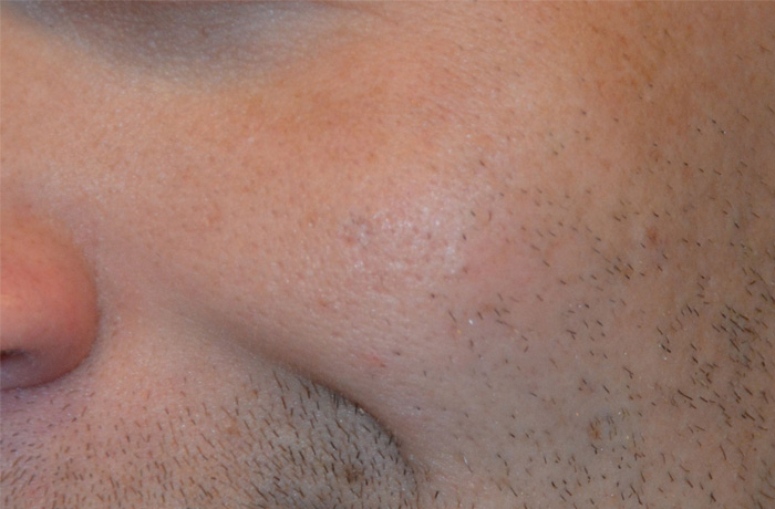 Mole Removal Real Patient Results by Dr. Scott Urban in Salt Lake City, Utah
