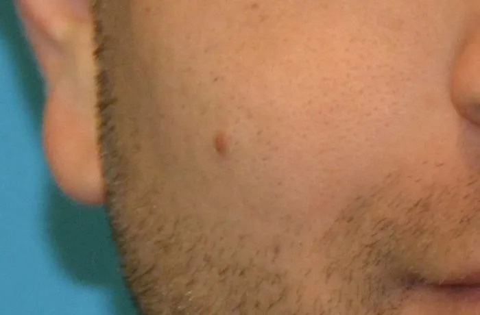 Mole Removal Real Patient Results by Dr. Scott Urban in Salt Lake City, Utah