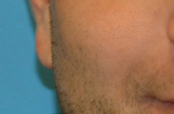 Mole Removal Real Patient Results by Dr. Scott Urban in Salt Lake City, Utah