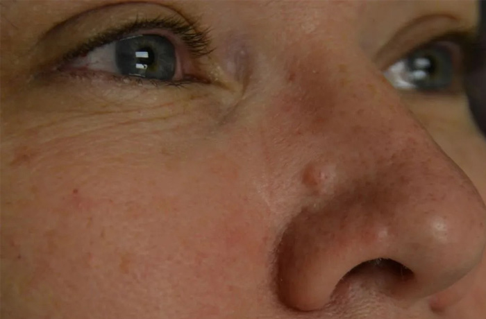 Mole Removal Real Patient Results by Dr. Scott Urban in Salt Lake City, Utah