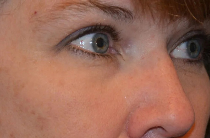 Mole Removal Real Patient Results by Dr. Scott Urban in Salt Lake City, Utah