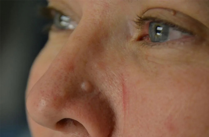 Mole Removal Real Patient Results by Dr. Scott Urban in Salt Lake City, Utah