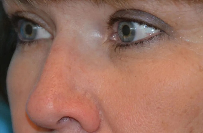 Mole Removal Real Patient Results by Dr. Scott Urban in Salt Lake City, Utah