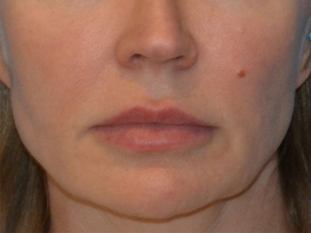 Cheek Implants Real Patient Results by Dr. Scott Urban in Salt Lake City, Utah