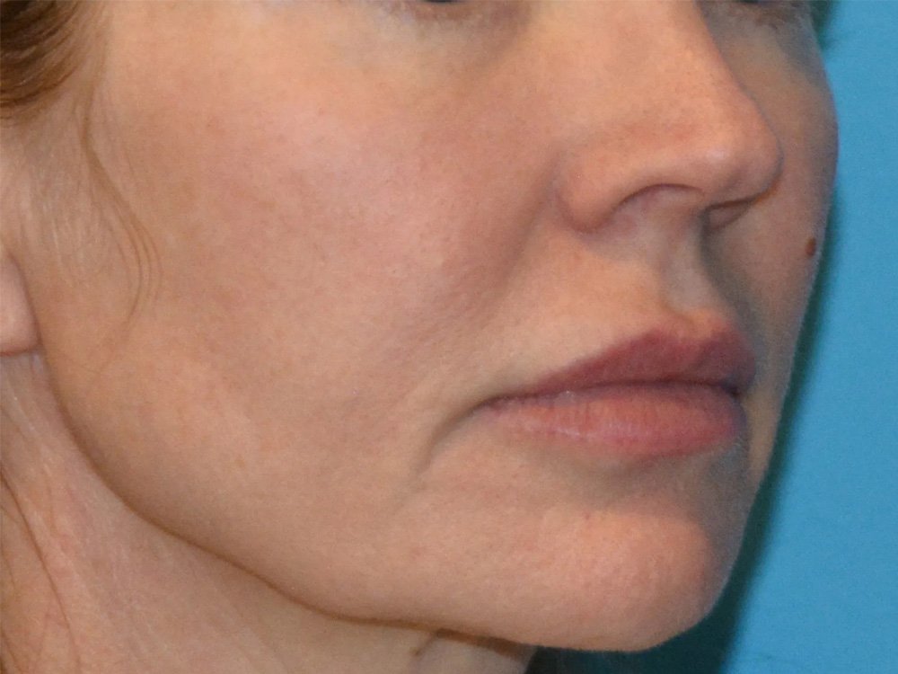 Cheek Implants Real Patient Results by Dr. Scott Urban in Salt Lake City, Utah