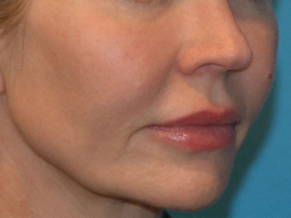 Cheek Implants Real Patient Results by Dr. Scott Urban in Salt Lake City, Utah