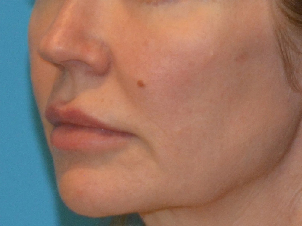 Cheek Implants Real Patient Results by Dr. Scott Urban in Salt Lake City, Utah