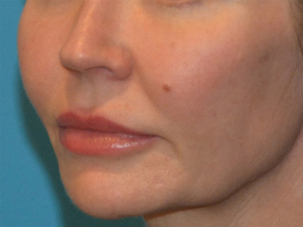 Cheek Implants Real Patient Results by Dr. Scott Urban in Salt Lake City, Utah
