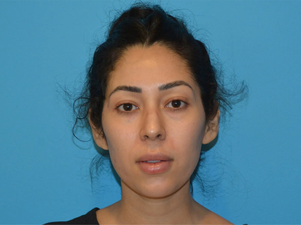 Cheek Implants Real Patient Results by Dr. Scott Urban in Salt Lake City, Utah