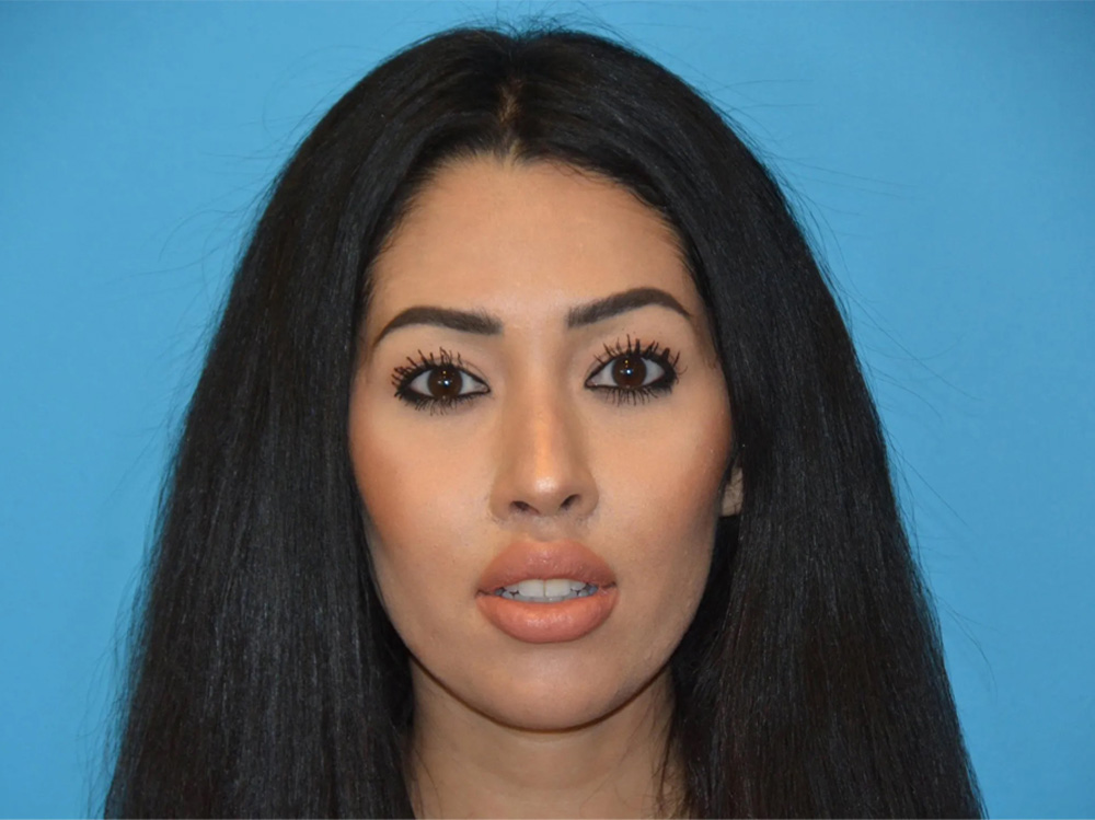Cheek Implants Real Patient Results by Dr. Scott Urban in Salt Lake City, Utah