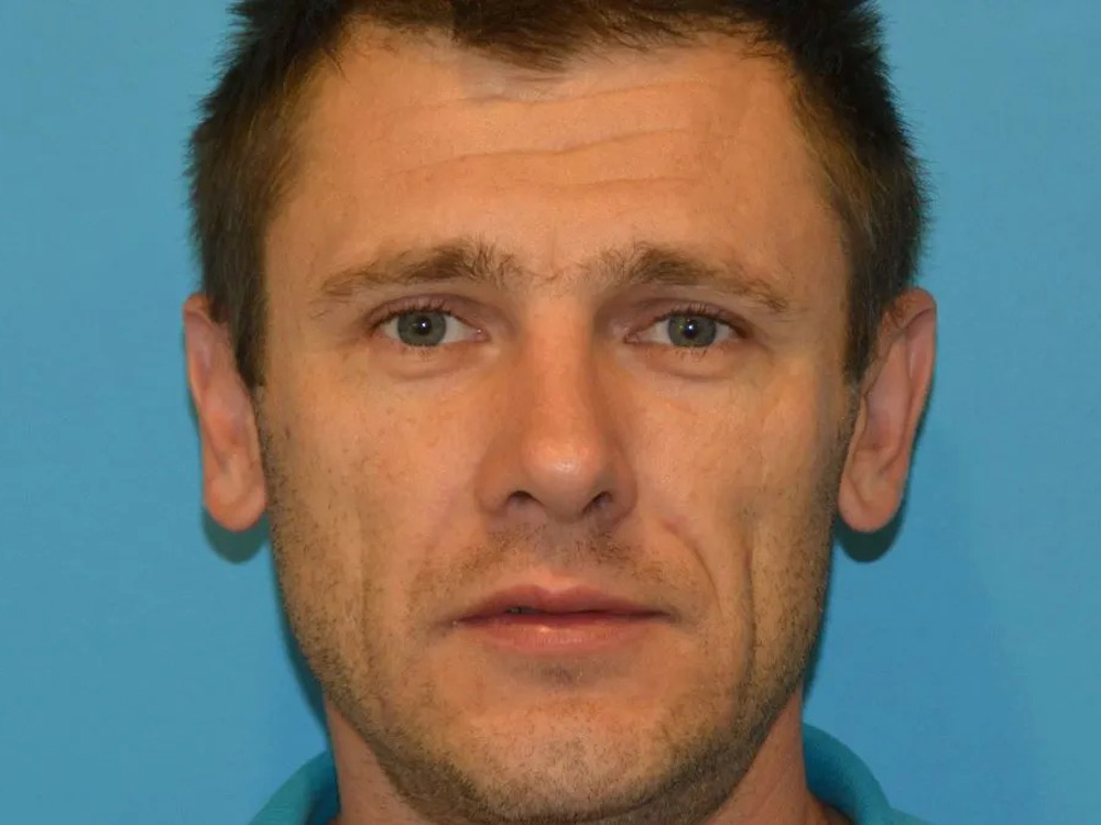 Cheek Implants Real Patient Results by Dr. Scott Urban in Salt Lake City, Utah