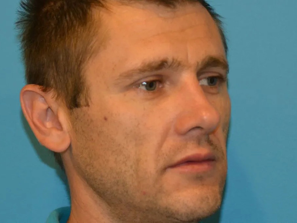 Cheek Implants Real Patient Results by Dr. Scott Urban in Salt Lake City, Utah