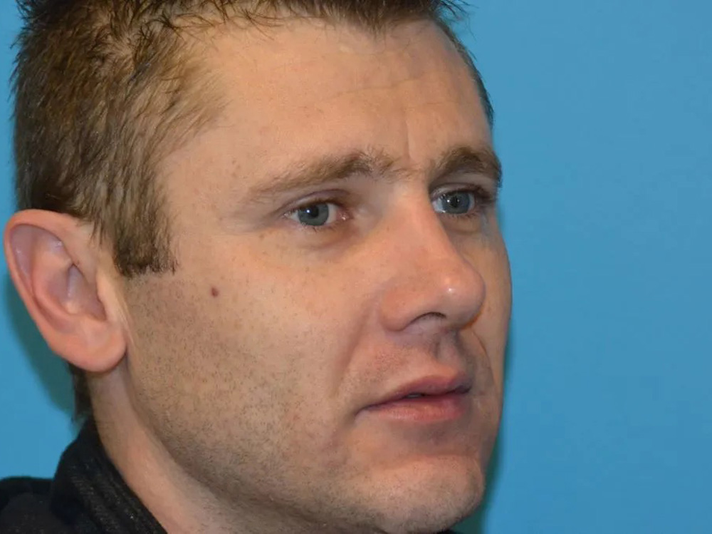 Cheek Implants Real Patient Results by Dr. Scott Urban in Salt Lake City, Utah