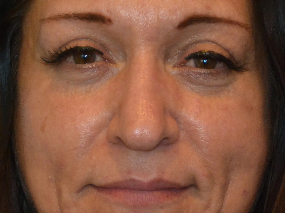 Cheek Implants Real Patient Results by Dr. Scott Urban in Salt Lake City, Utah