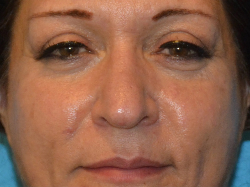 Cheek Implants Real Patient Results by Dr. Scott Urban in Salt Lake City, Utah