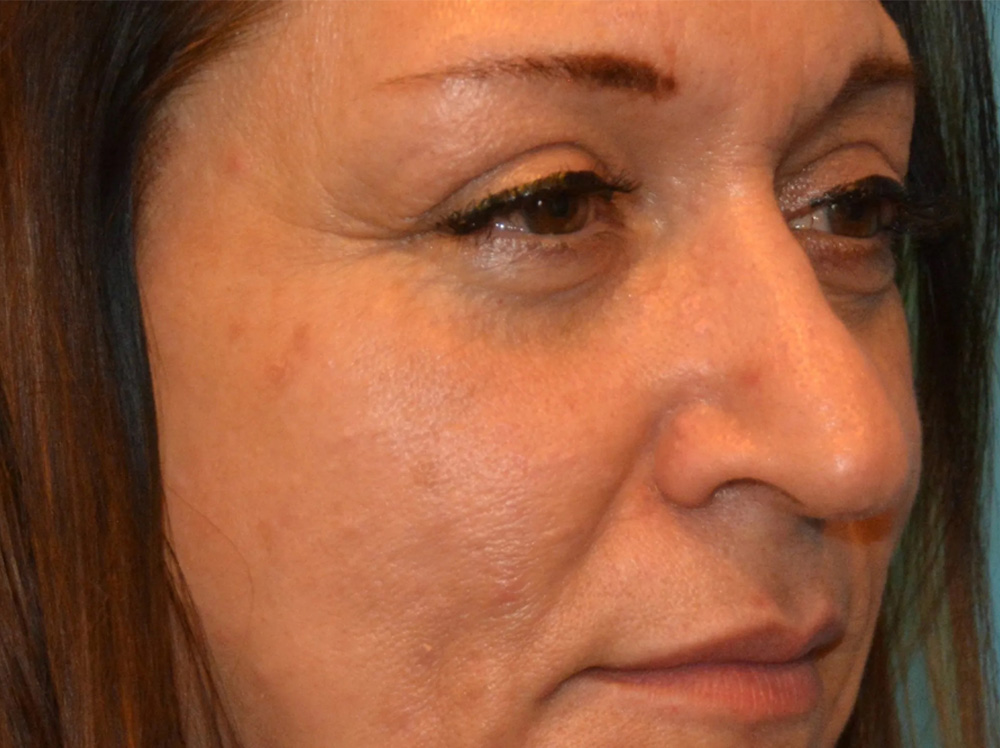Cheek Implants Real Patient Results by Dr. Scott Urban in Salt Lake City, Utah